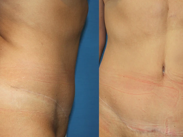 Mageplastikk etter vekttap